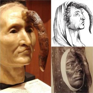 A bizarre 19th-century woman with a 9.8-inch male penis growing from her forehead is now on display at the Mütter Museum in Philadelphia.